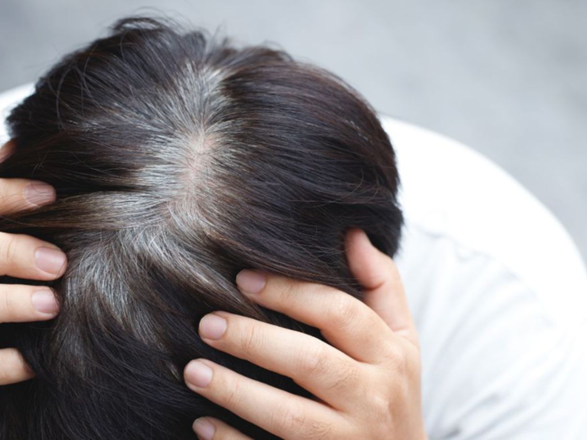 Khi căng thẳng, cơ thể sản sinh cortisol, có thể làm suy yếu nang tóc