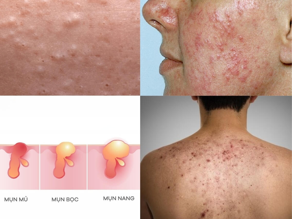 Các loại mụn ở nam giới