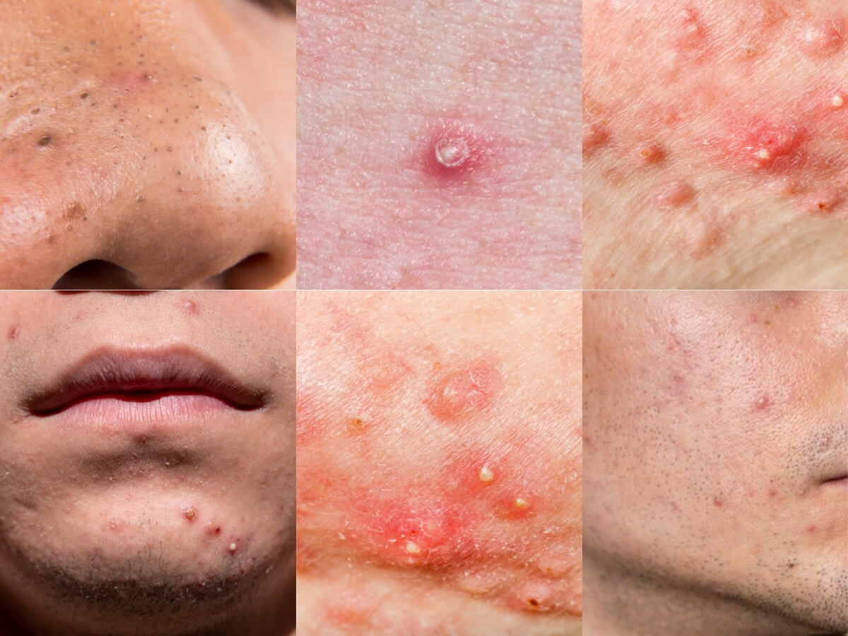 Các loại mụn thường gặp ở nam giới