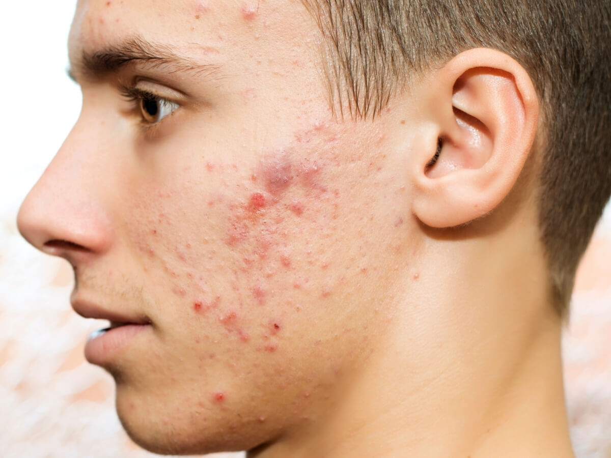 Nguyên nhân gây ra mụn ở nam giới