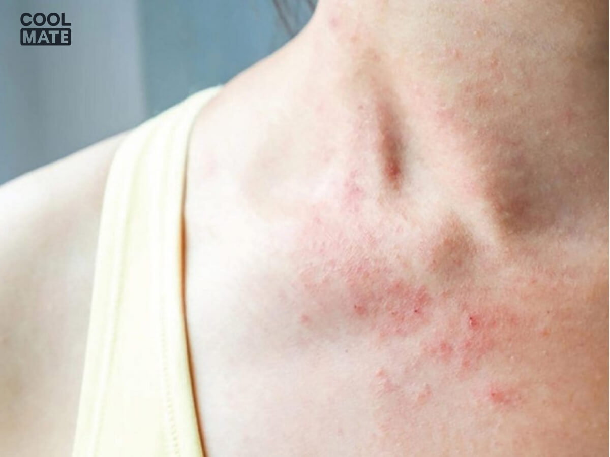 sử dụng nước hoa giả có thể gây kích dứng da