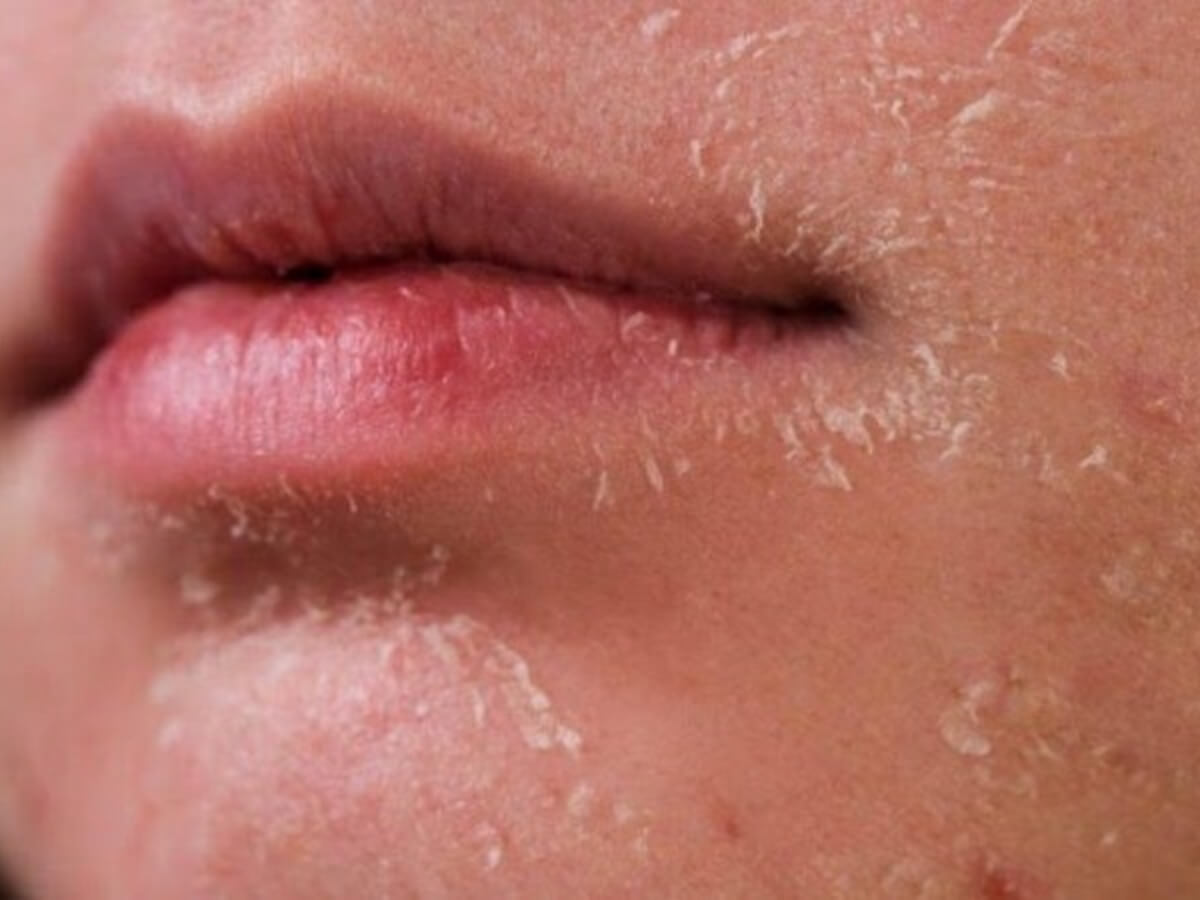 Da nam khô ráp vào mùa lạnh do độ ẩm giảm, gió lạnh và thói quen sinh hoạt