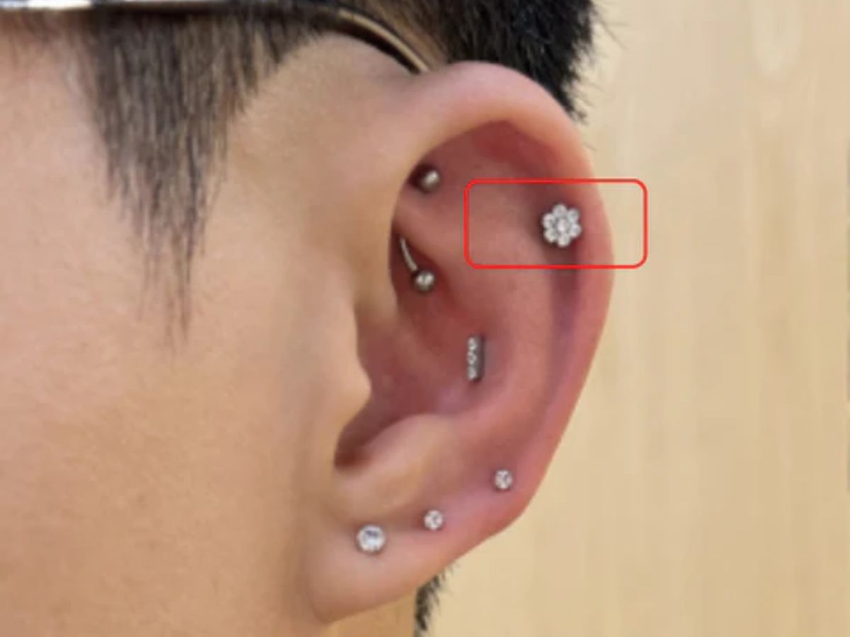 Flat là vị trí nằm trên vùng sụn phẳng và rộng ở phía trong vành tai